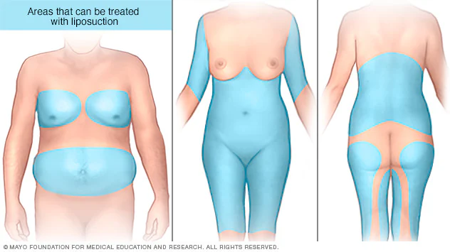 Professional Obesity Surgery Operations Accompanied by Expert Doctors at Ibni Sina Health.